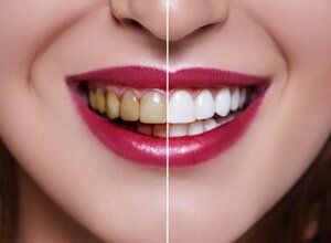 Woman Teeth Before and After Teeth Whitening— Prosthodontics in Beaumont, TX Woman Teeth Before and After Teeth Whitening— Prosthodontics in Beaumont, TX
