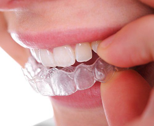 Invisalign clear aligner close up