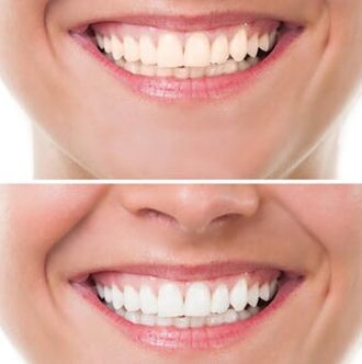 Cosmetic - Dentist in Olympia, WA