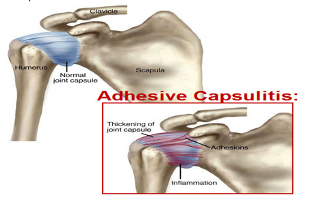 A diagram of a shoulder with adhesive capsulitis.