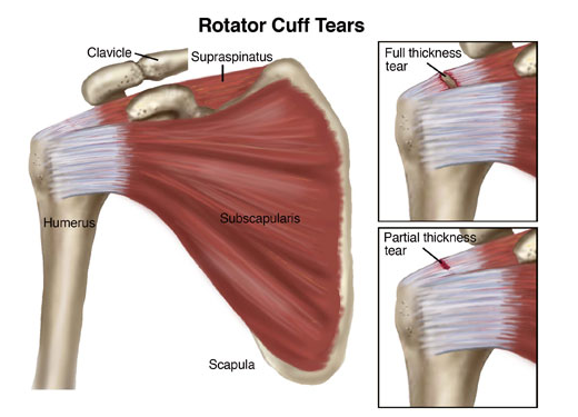A diagram of the rotator cuff tears of the shoulder