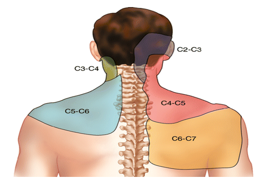 A diagram of a person 's back showing the different areas of pain