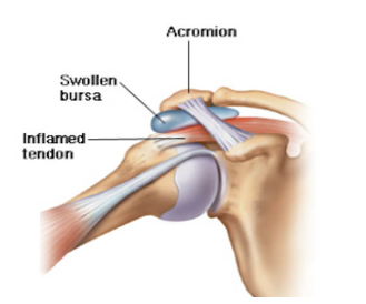 A diagram of a shoulder showing a swollen bursa and an inflamed tendon