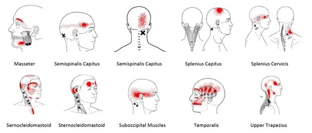 A drawing of a person 's head with different areas of pain.