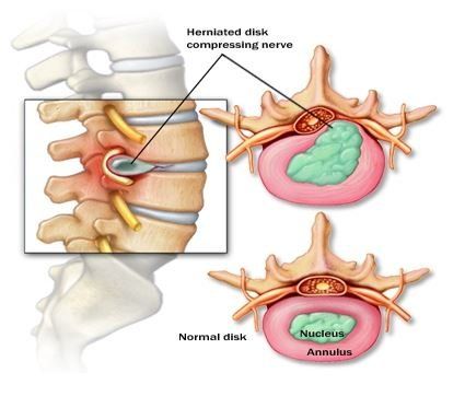 Back Disk Pain