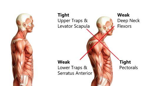 Trigger Points
