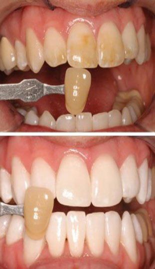 After Teeth Cleaning — Terre Haute, IN — Roshel Family Dentistry After Teeth Cleaning — Terre Haute, IN — Roshel Family Dentistry