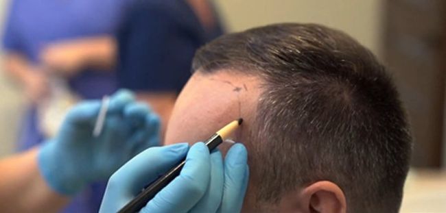 Best Hair Loss Treatment