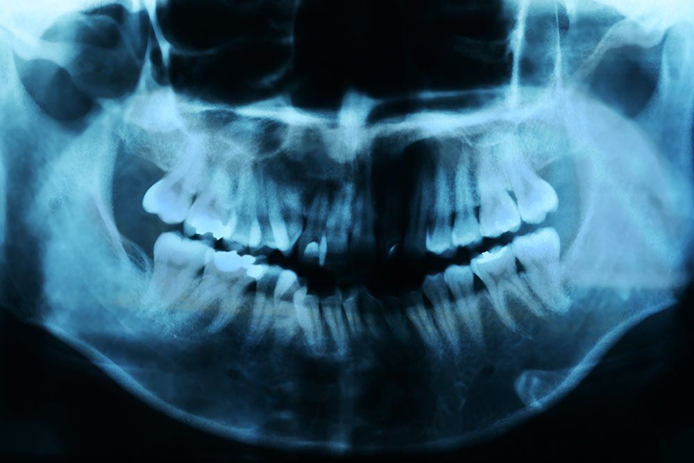 Root Canal Treatment xray of teeth