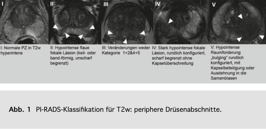 Pirads Klassifikation für zentrale Drüsenabschnitte in T2-Wichtung (aus Röthke 2013) Pirads Klassifikation für periphere Drüsenabschnitte in T2-Wichtung (aus Röthke 2013)
