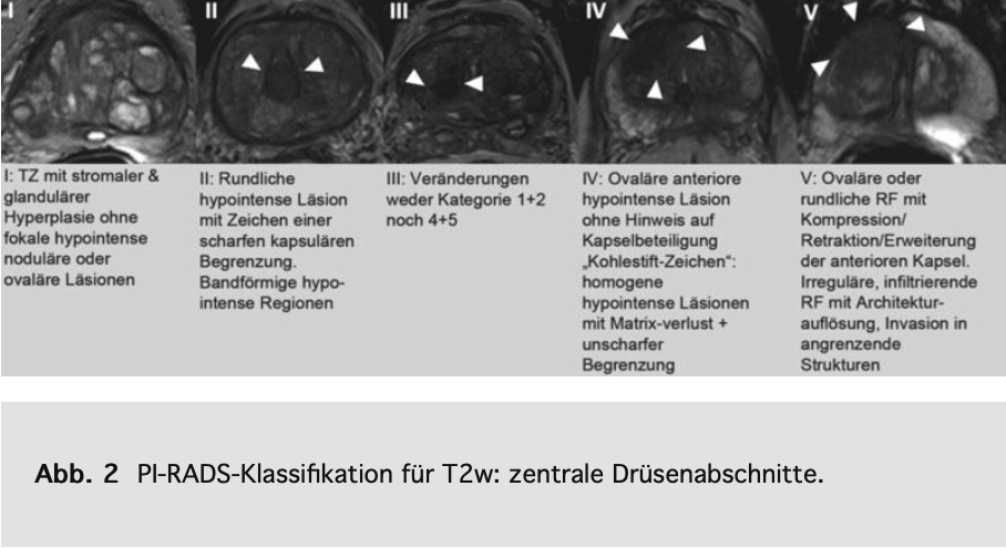 Pirads Klassifikation für zentrale Drüsenabschnitte in T2-Wichtung (aus Röthke 2013) Pirads Klassifikation für zentrale Drüsenabschnitte in T2-Wichtung (aus Röthke 2013)