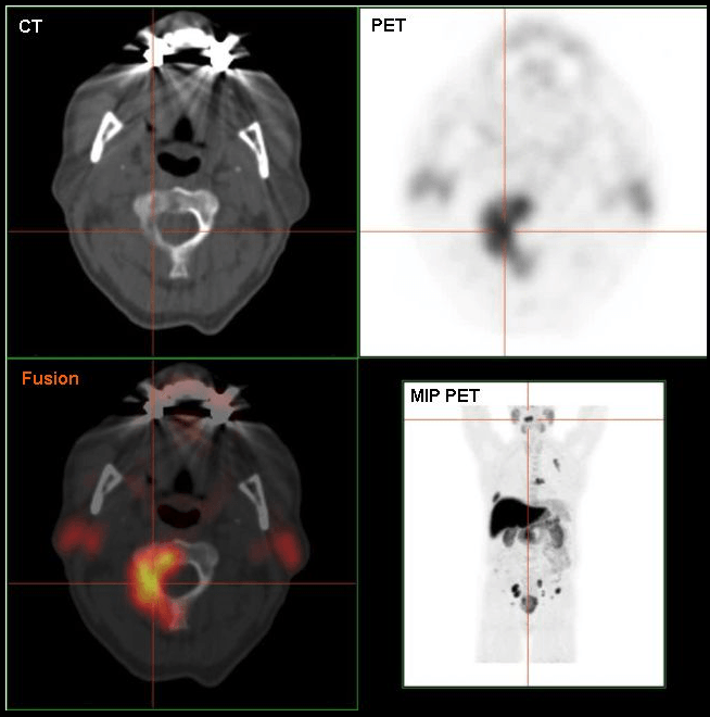 F-18 Cholin-PET/CT einer Metastase im 2. Halswirbelkörper - Quelle: Wikipedia (User:Hg6996) F-18 Cholin-PET/CT einer Metastase im 2. Halswirbelkörper - Quelle: Wikipedia (User:Hg6996)