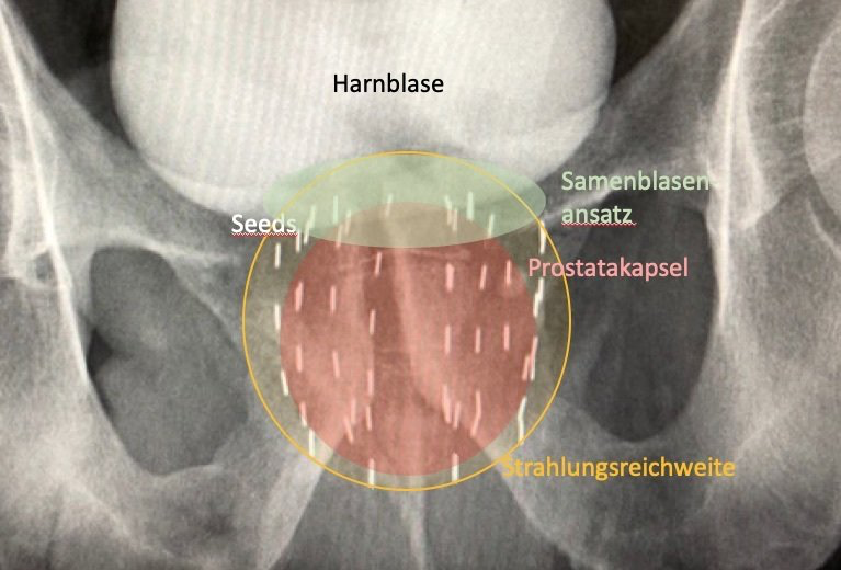 Strahlungsreichweite bei LDR-Brachytherapie (Seedimplantation)