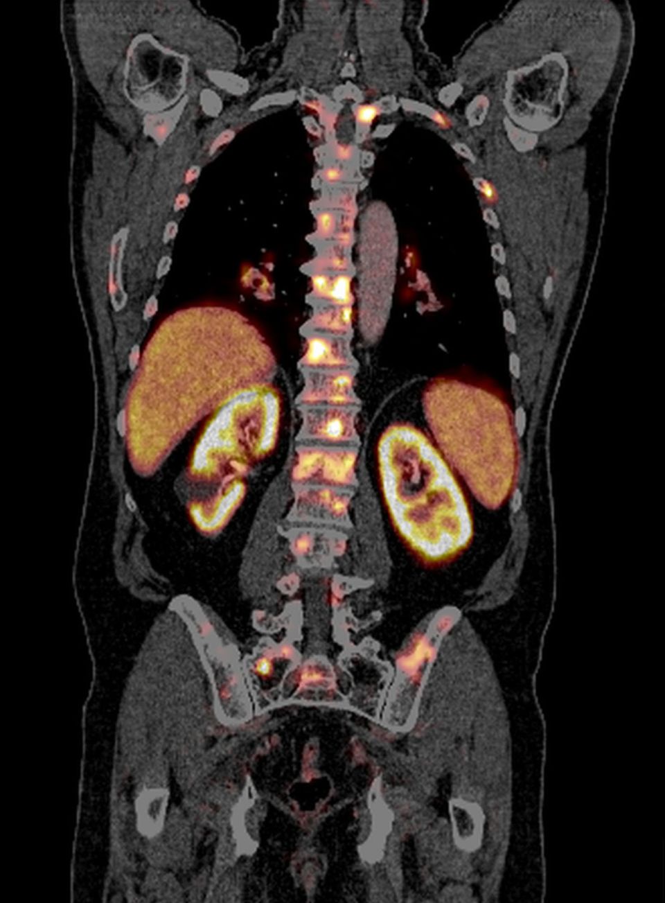 Oligometastasierung im PSMA-PET/CT - der Nachweis vieler Metastasen ist derzeit Voraussetzung für die Durchführung dieser innovativen Therapie Oligometastasierung im PSMA-PET/CT - der Nachweis vieler Metastasen ist derzeit Voraussetzung für die Durchführung dieser innovativen Therapie