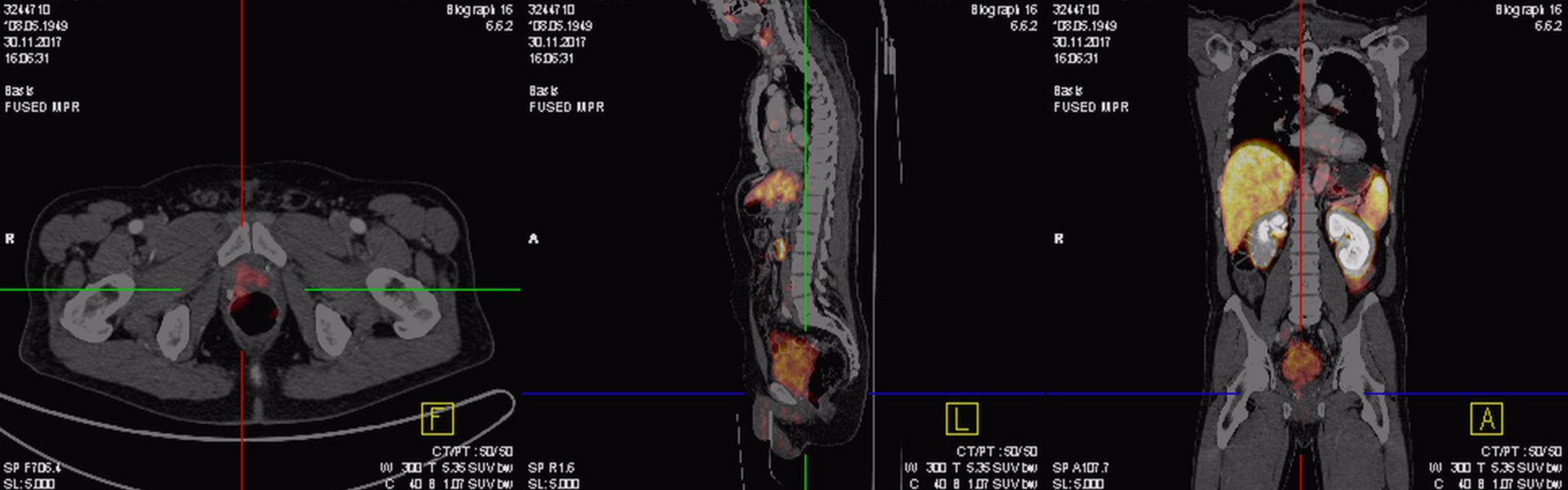Lokalrezidiv nach Radikaloperation im PSMA-PET/CT Lokalrezidiv nach Radikaloperation im PSMA-PET/CT
