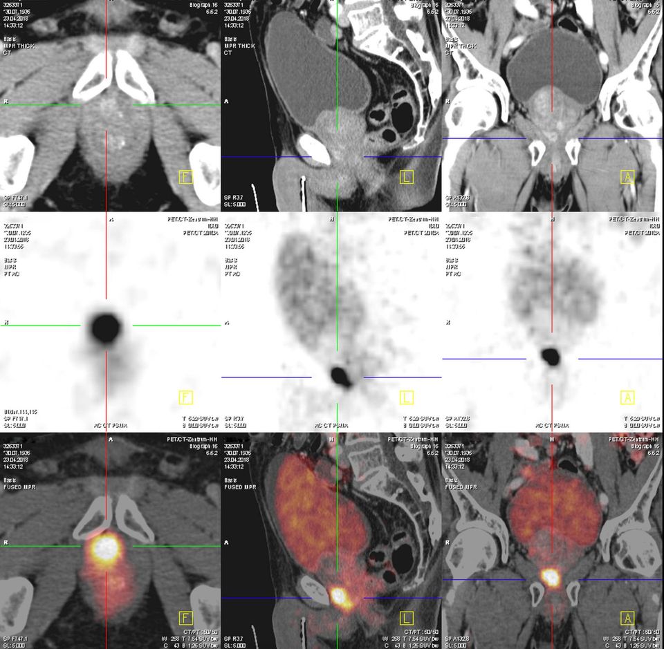 PSMA-PET/CT Fokaler Prostatakrebs PSMA-PET/CT Fokaler Prostatakrebs