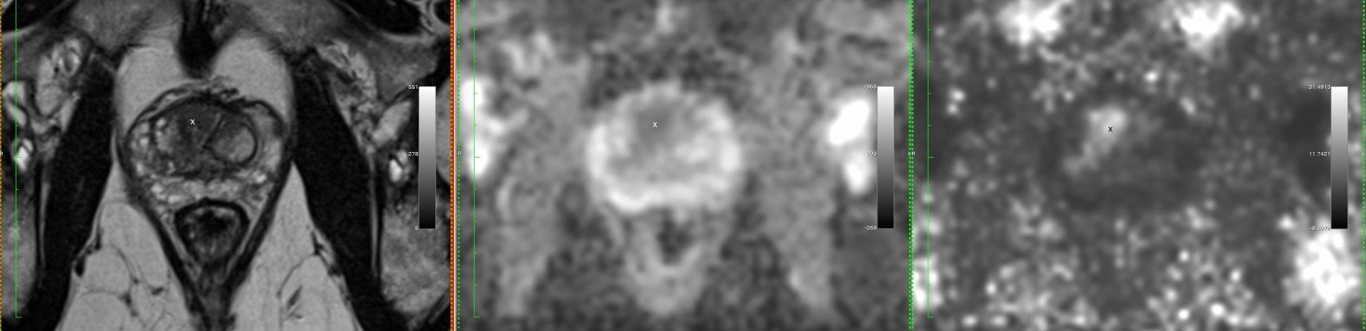 mp-MRT, bestehend aus T2w (links), Diffusionswichtung DWI (Mitte) und DCE (rechts) - jedes Untersuchungsverfahren hat seine eigene charakteristische Tumordarstellung (Copyright PD Dr. Röthke, Conradia Hamburg) mp-MRT, bestehend aus T2w (links), Diffusionswichtung DWI (Mitte) und DCE (rechts) - jedes Untersuchungsverfahren hat seine eigene charakteristische Tumordarstellung (Copyright PD Dr. Röthke, Conradia Hamburg)