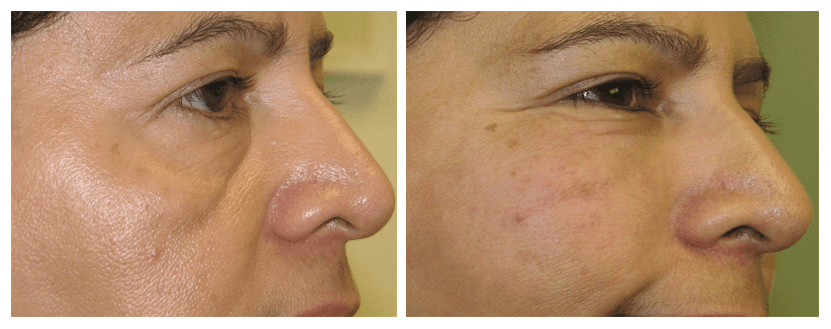 Non surgical cheek augmentation