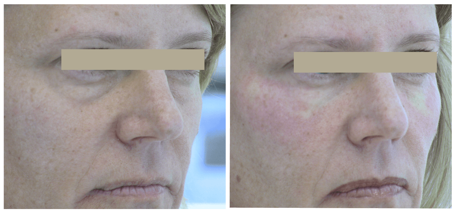cheek augmentation will fillers