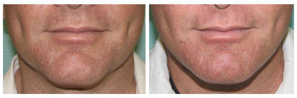 non-surgical chin augmentation