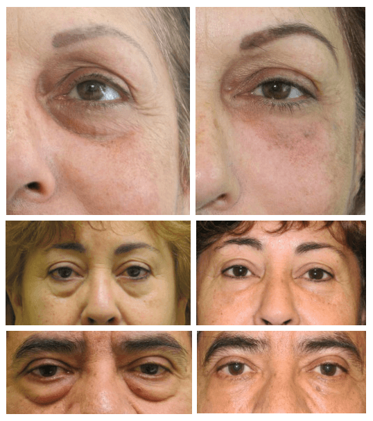 non-surgical eye bags removal