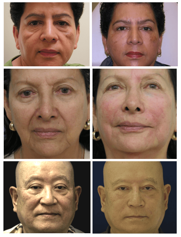 non-surgical face lift