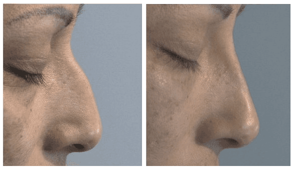 non surgical rhinoplasty