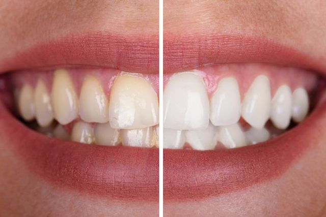 Before and After Teeth Whitening — Metairie, LA — Jeffry Leeson, DDS Before and After Teeth Whitening — Metairie, LA — Jeffry Leeson, DDS