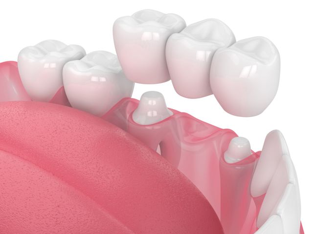 Prosthetic Teeth — Metairie, LA — Jeffry Leeson, DDS Prosthetic Teeth — Metairie, LA — Jeffry Leeson, DDS