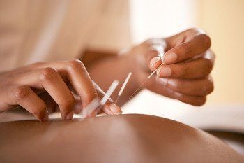 Acupuncture treatment in progress