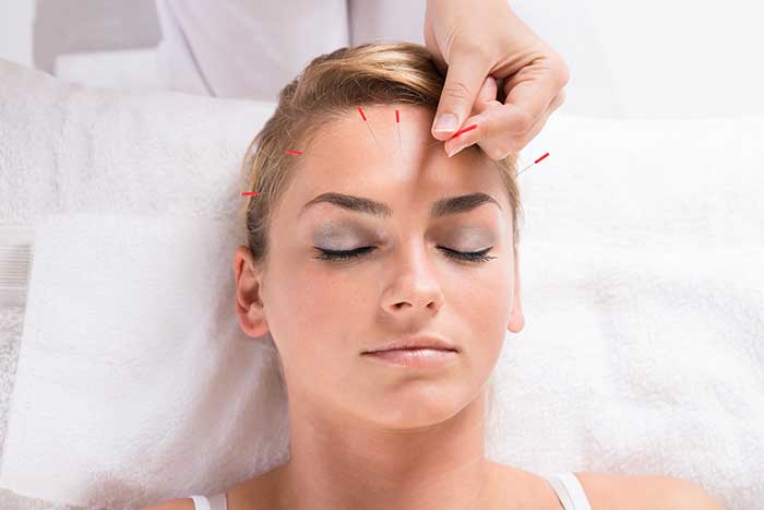 Acupuncture, London