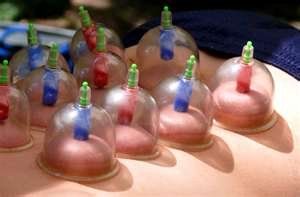 A person is getting cupping treatment on their back.