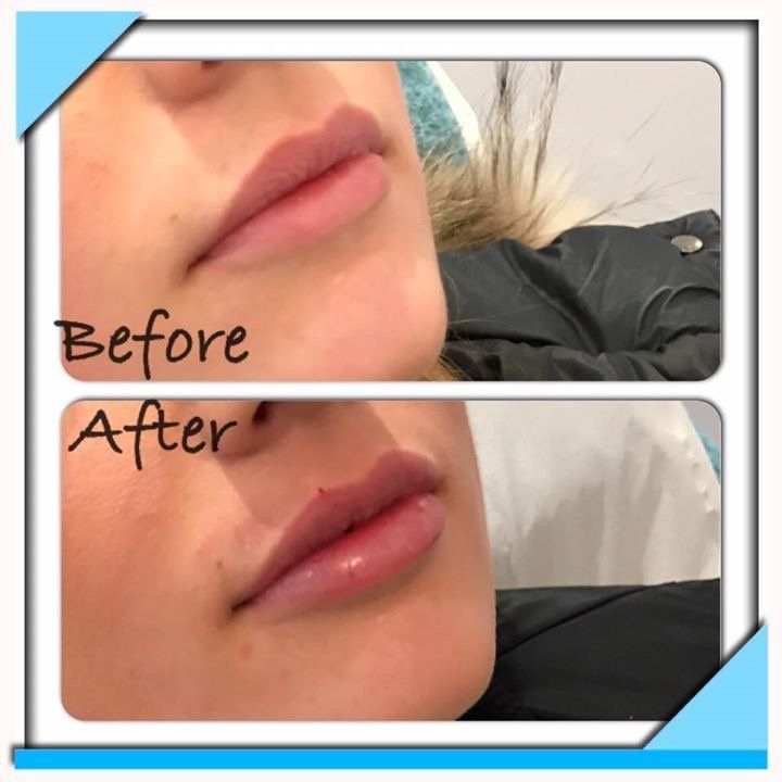lips before and after