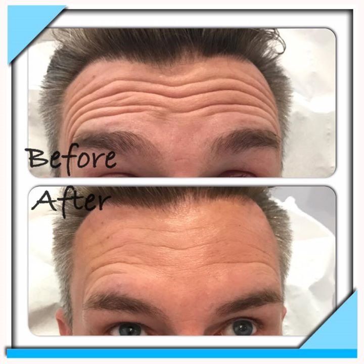 forehead before and after
