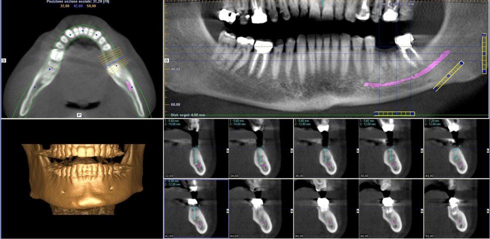 tomografia computerizzata Cone Beam - TAC dentale