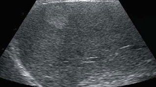 Echographie Abdominale