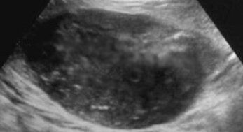 Echographie Thyroide Muscle Tendon