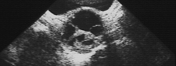 Echographie Pelvienne