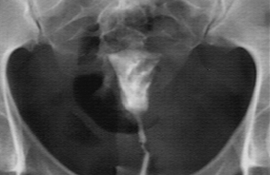 Radiologie Hystérographie CIN Paris Daumesnil