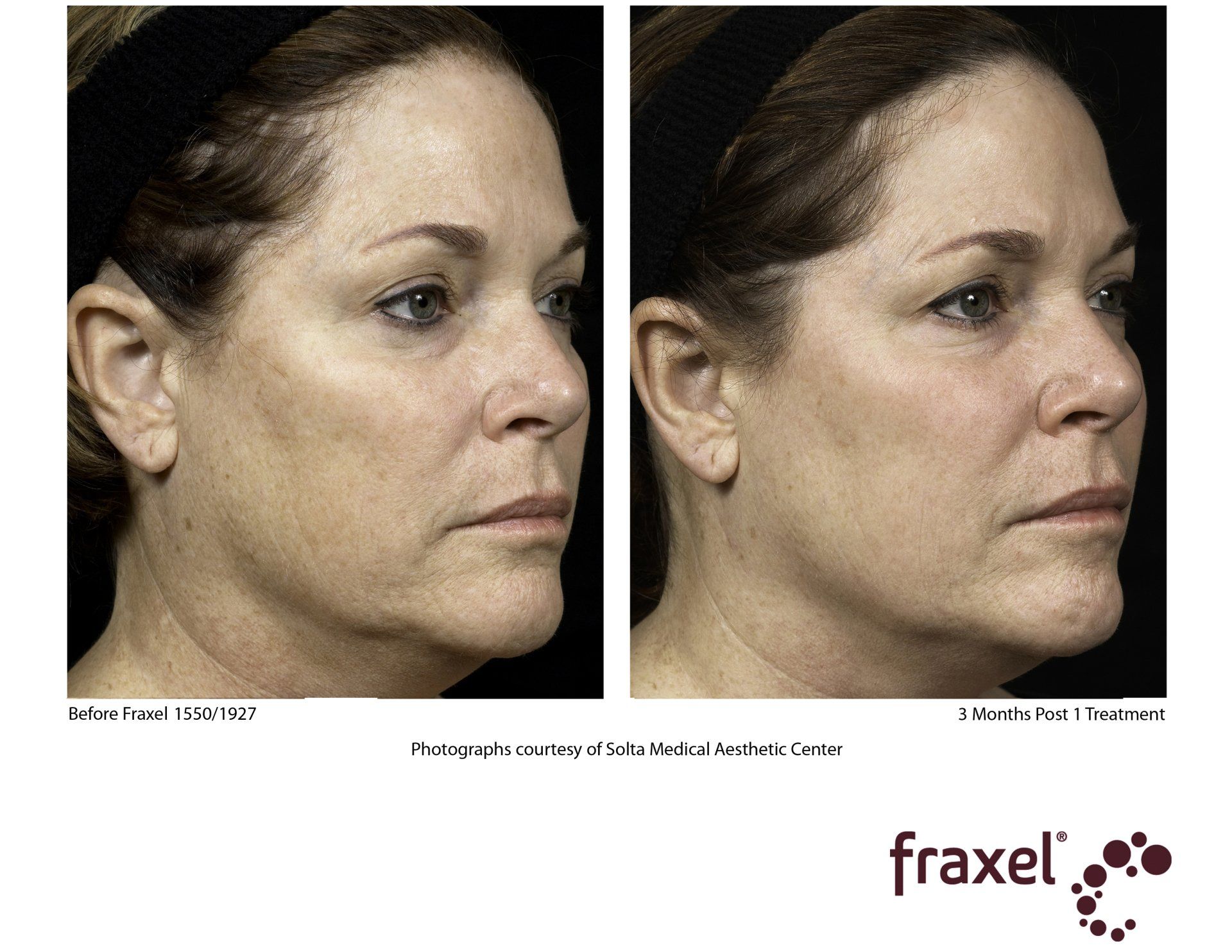 before and after Fraxel laser treatment