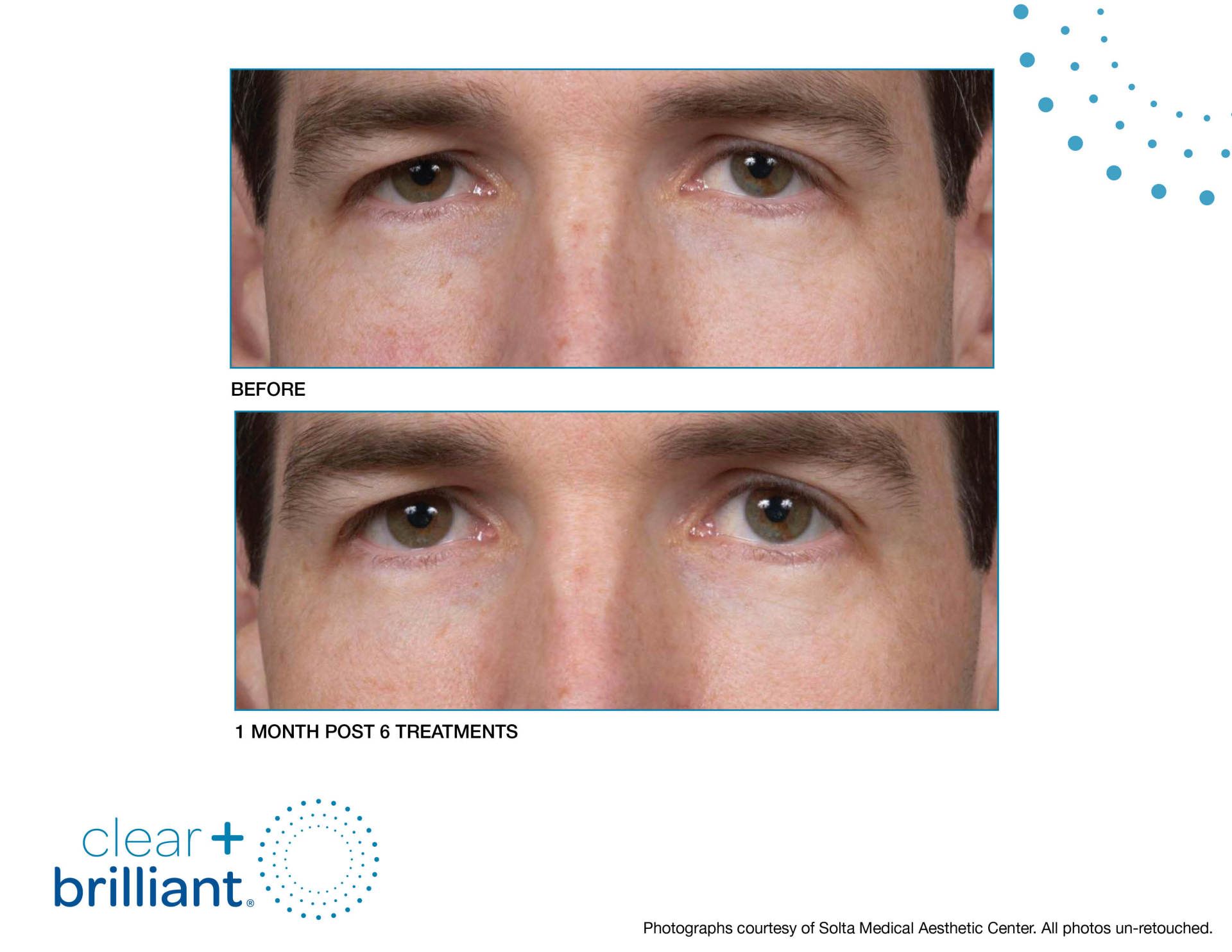 before and after clear + brilliant laser treatment on eyes