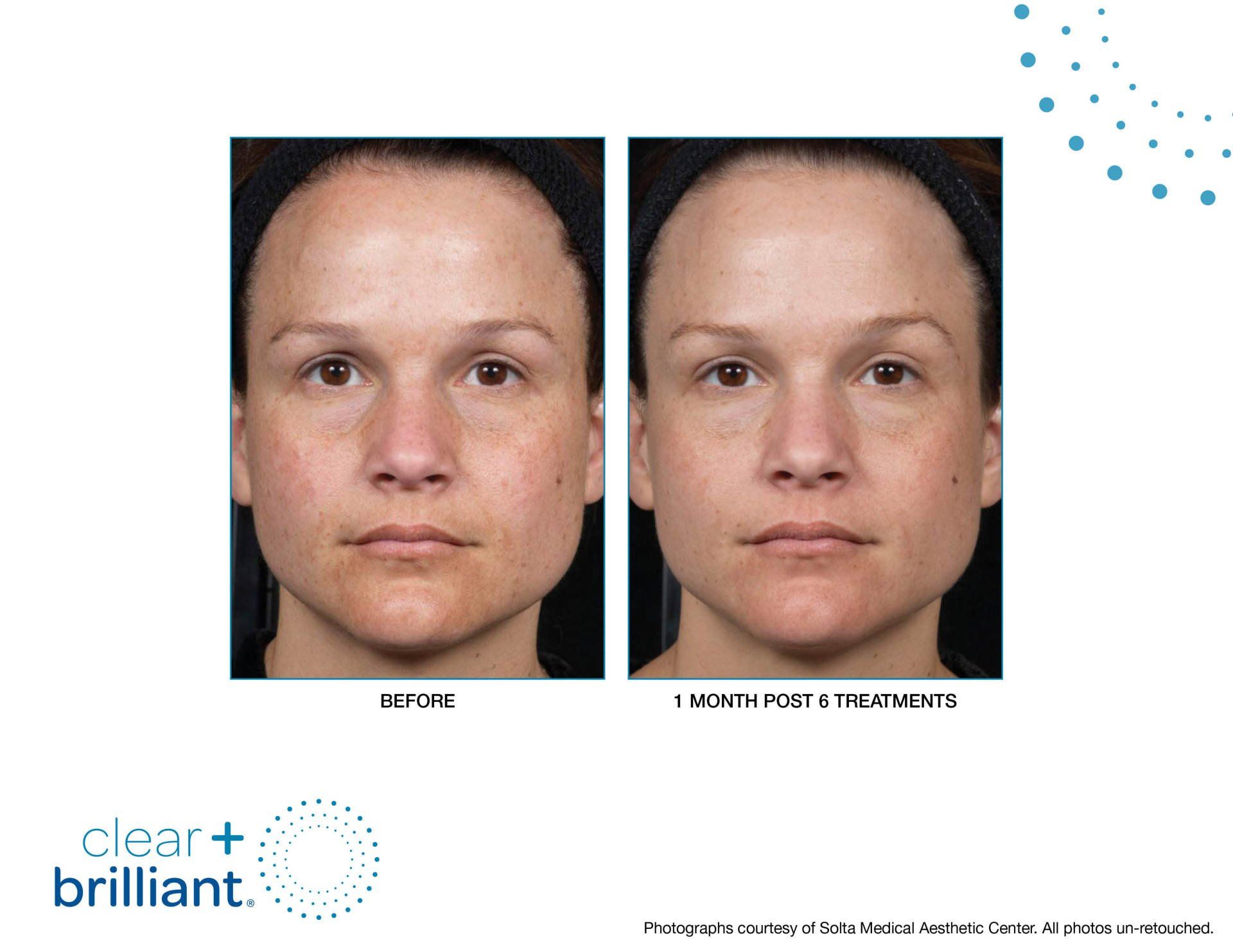 before and after clear + brilliant laser treatment