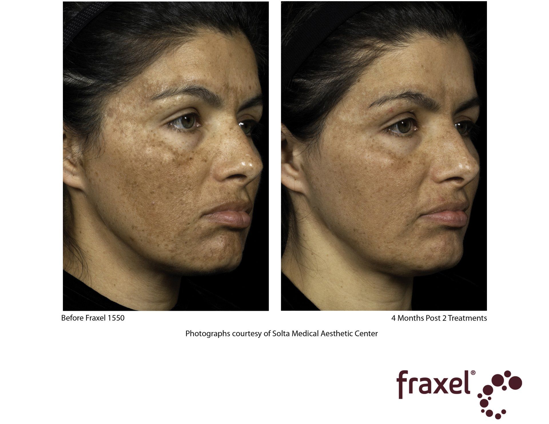 before and after Fraxel laser on scars