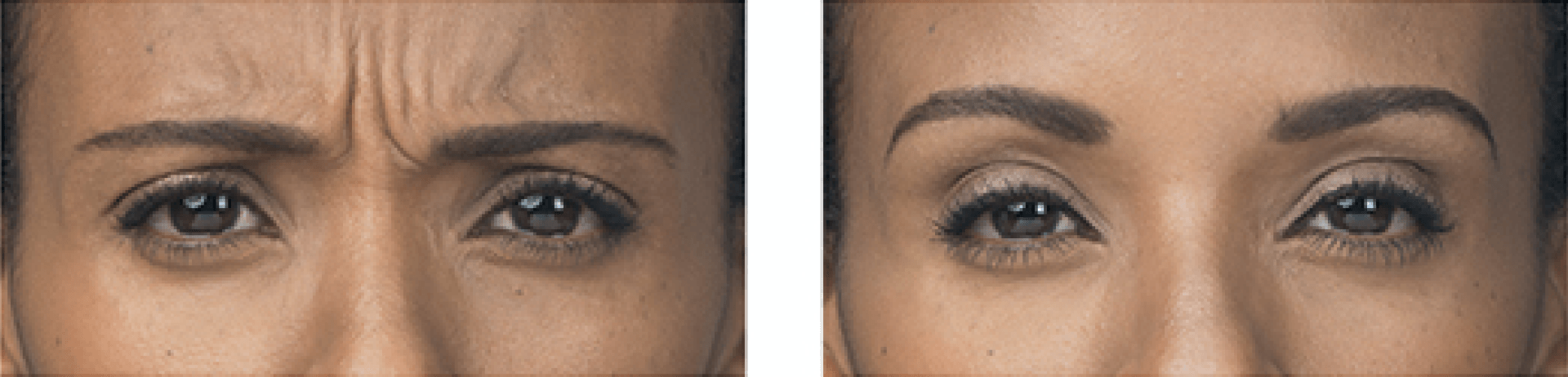 before and after botox treatment on forehead