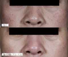 Excel V laser before and after treatment on eye bags