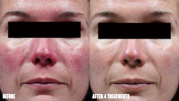 Excel V laser treatment before and after for skin redness