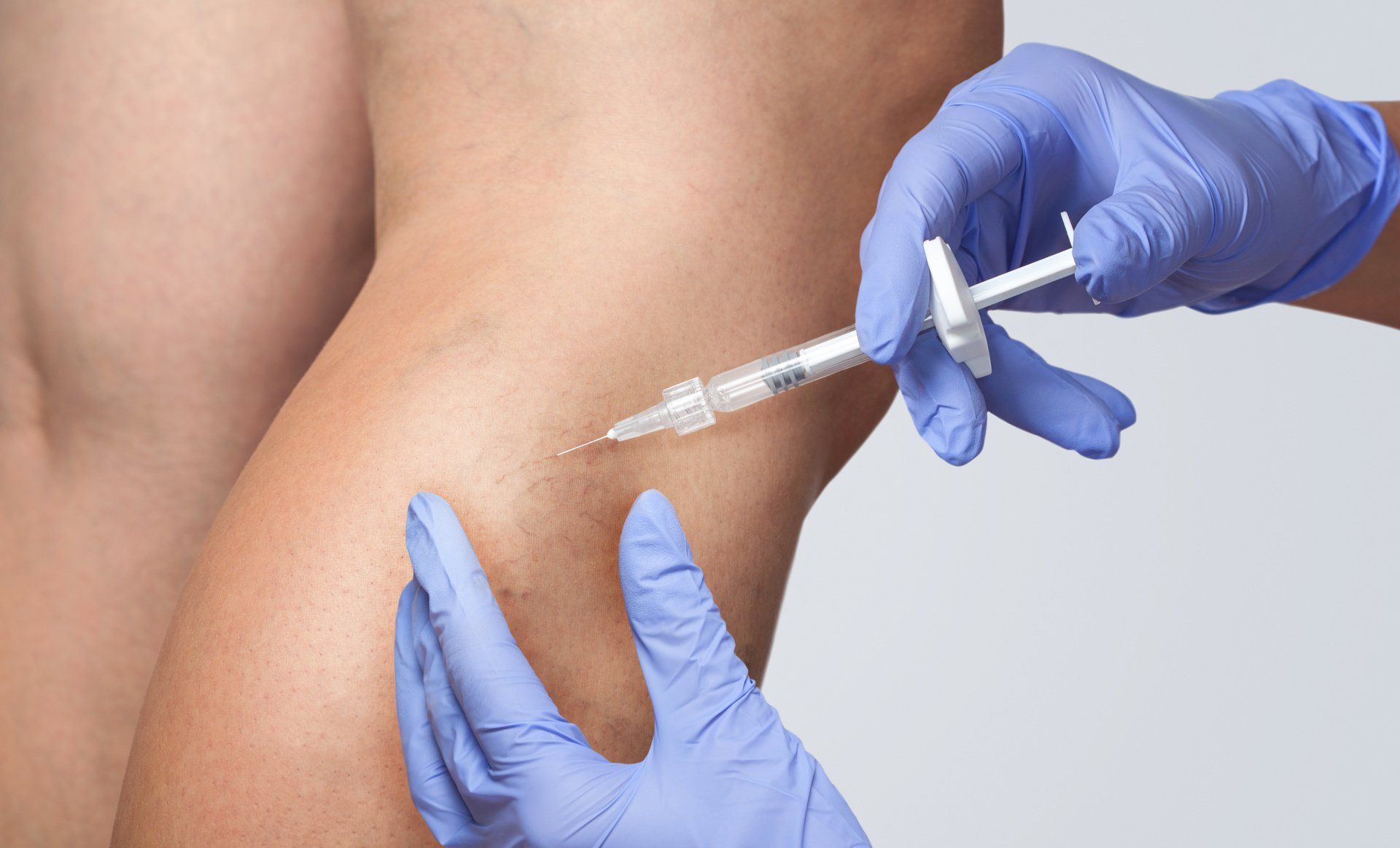 needle administering spider vein treatment on leg