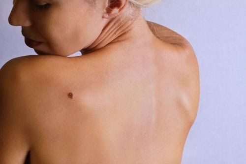 Melanoma on back