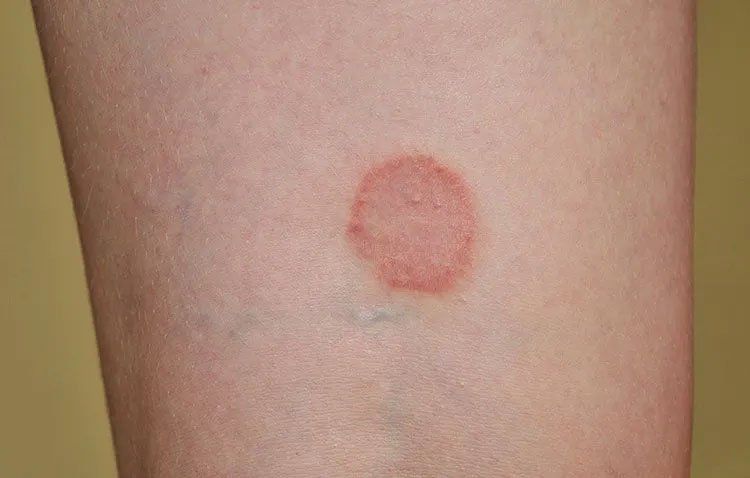 Ringworm on skin