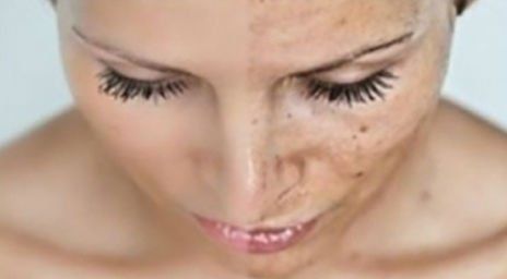viso di donna prima e dopo cura di patologia dermatologica
